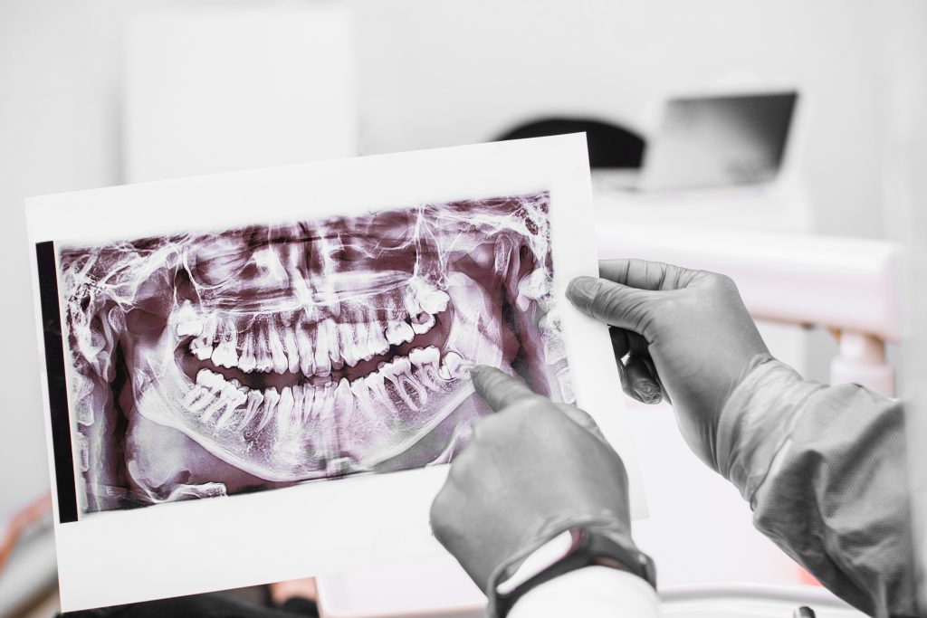Dientes incluidos: causas y consecuencias | CKA Grupo Dental
