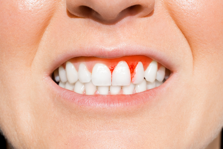 la piorrea dental